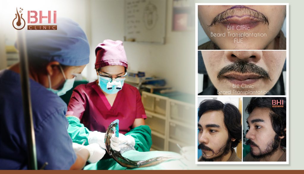 Beard transplant