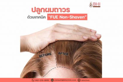 FUE Non-Shaven1
