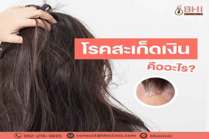 โรคสะเก็ดเงิน1